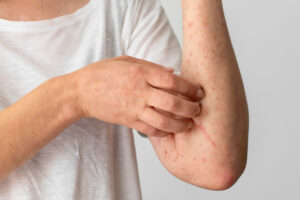 reaccion alergica cutanea brazo